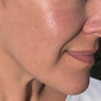 A close-up of a person's cheek, mouth, and nose showing natural skin texture.