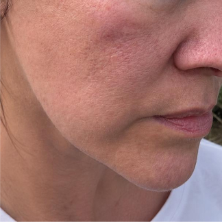 A close-up of a person's cheek showing skin texture with enlarged pores and some acne scarring.