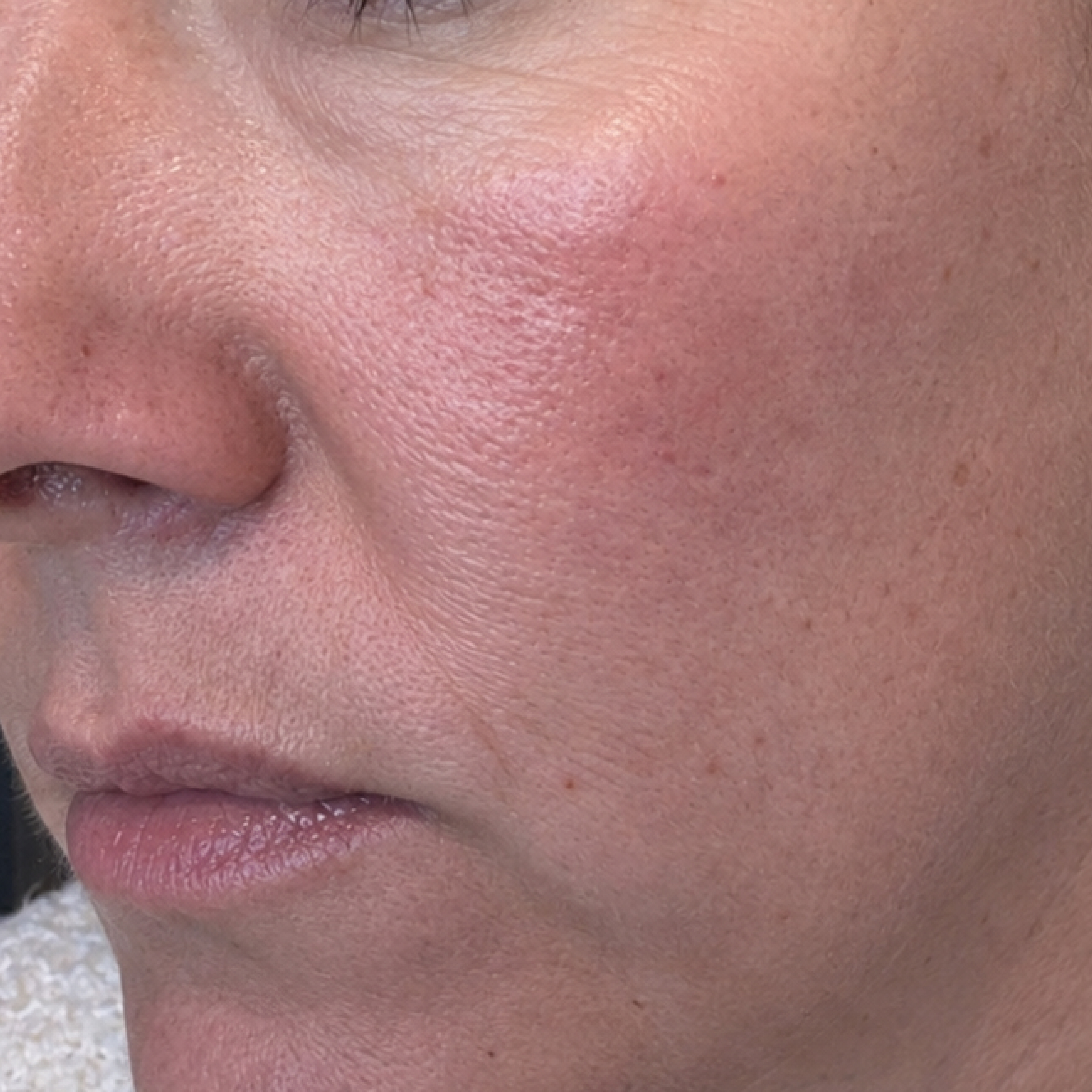 A close-up of a person's facial skin, showing pores, fine lines, and redness on the cheek.