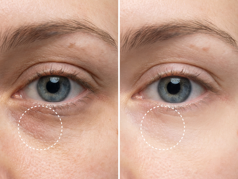 Close-up of eyes with under-eye circles before and after treatment.