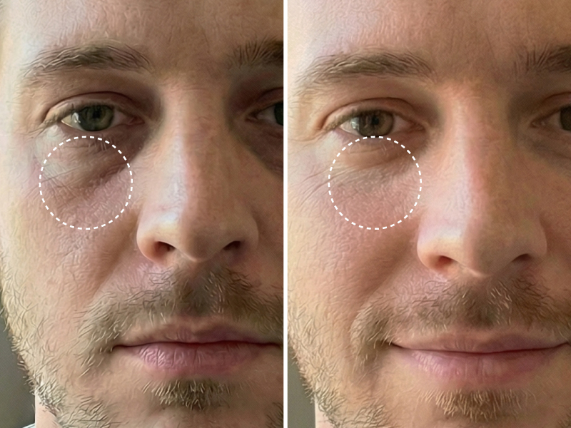 A before-and-after split image of a man's face showing a reduction in under-eye bags and wrinkles.