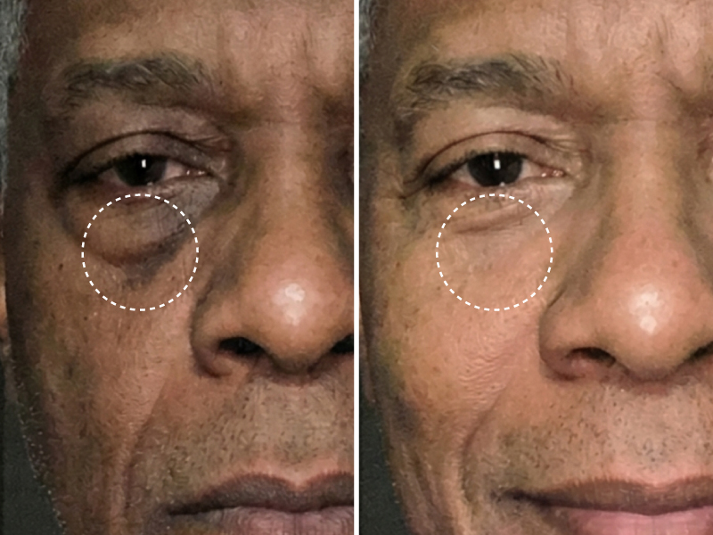 A before and after image showing a man's face with a significant reduction in under-eye bags.