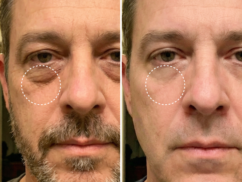 A before and after comparison of a man's face showing a reduction in under-eye wrinkles and bags.