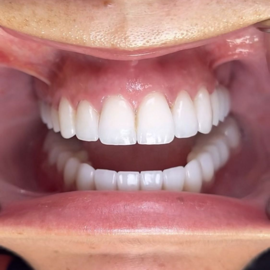 A close-up of a person's open mouth showing a full set of perfectly white, straight teeth.