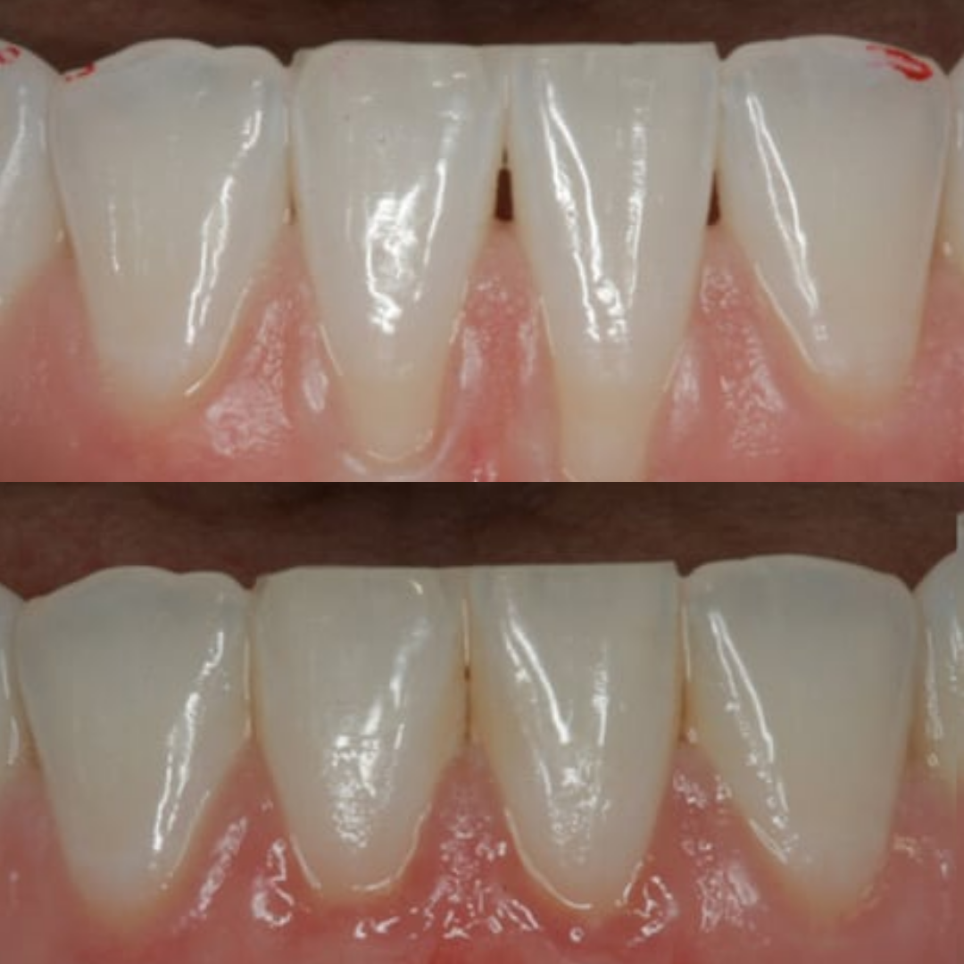 A before and after image showing dental work that has closed the gaps between the lower front teeth.