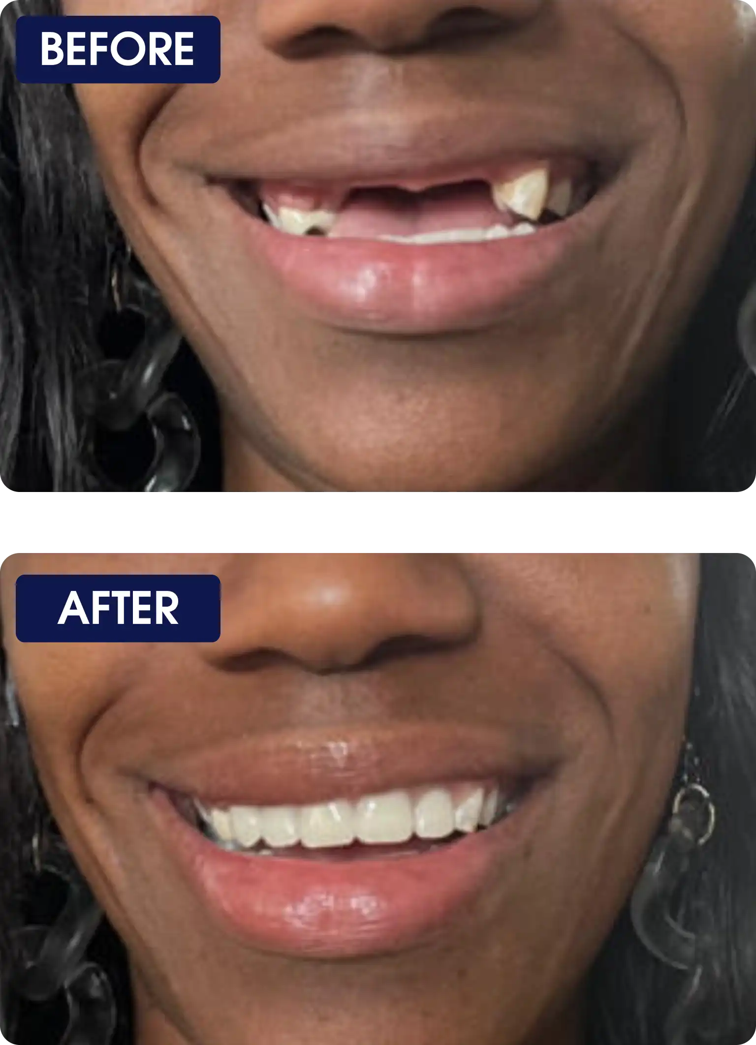 Before and after images of a person's smile, showing dental improvement.
