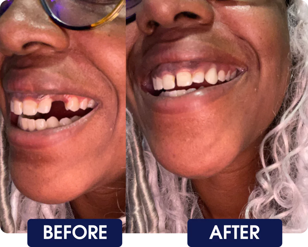 Side-by-side comparison of a person's smile before and after dental work.