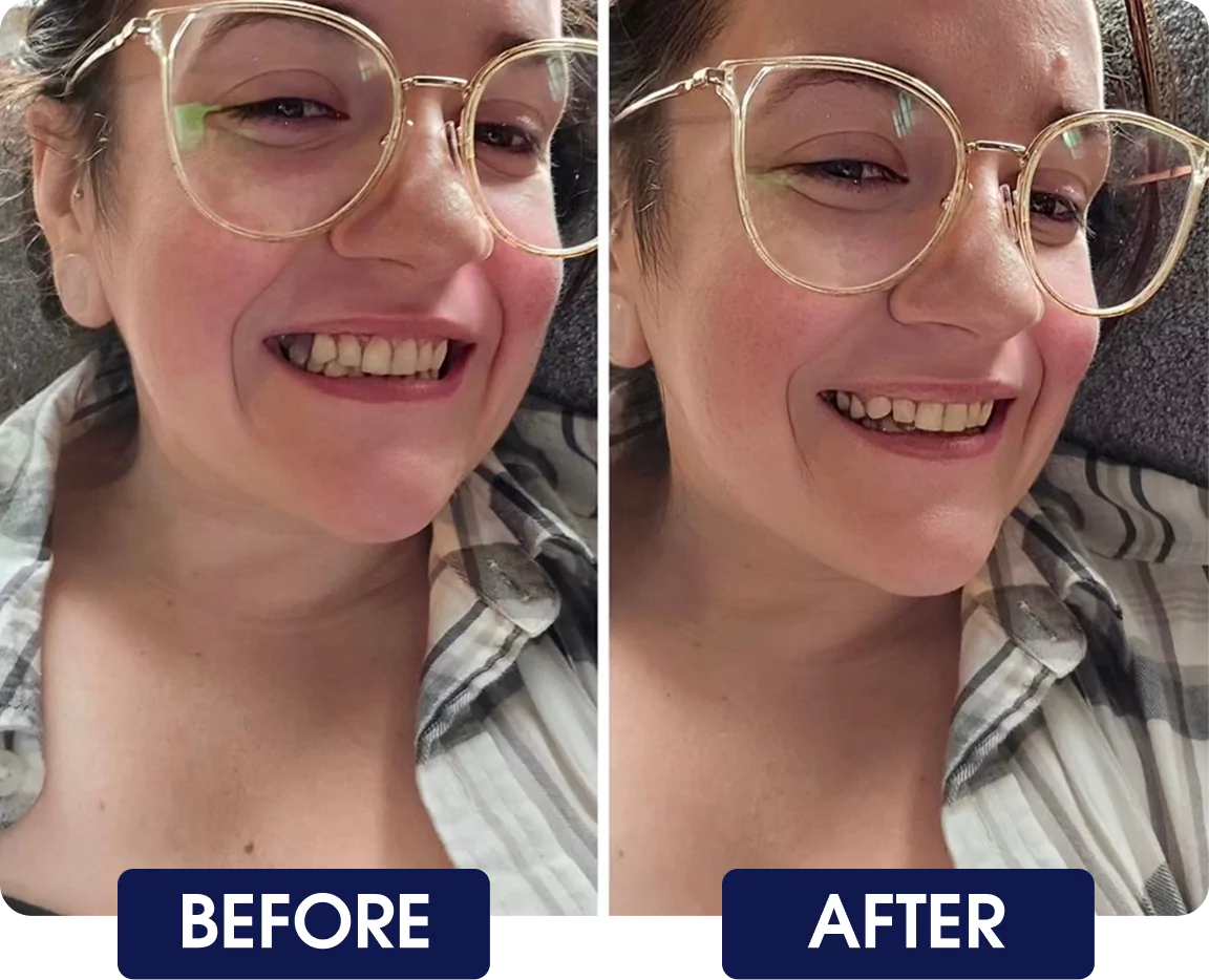 Side-by-side comparison of a person smiling, labeled 'Before' and 'After.'