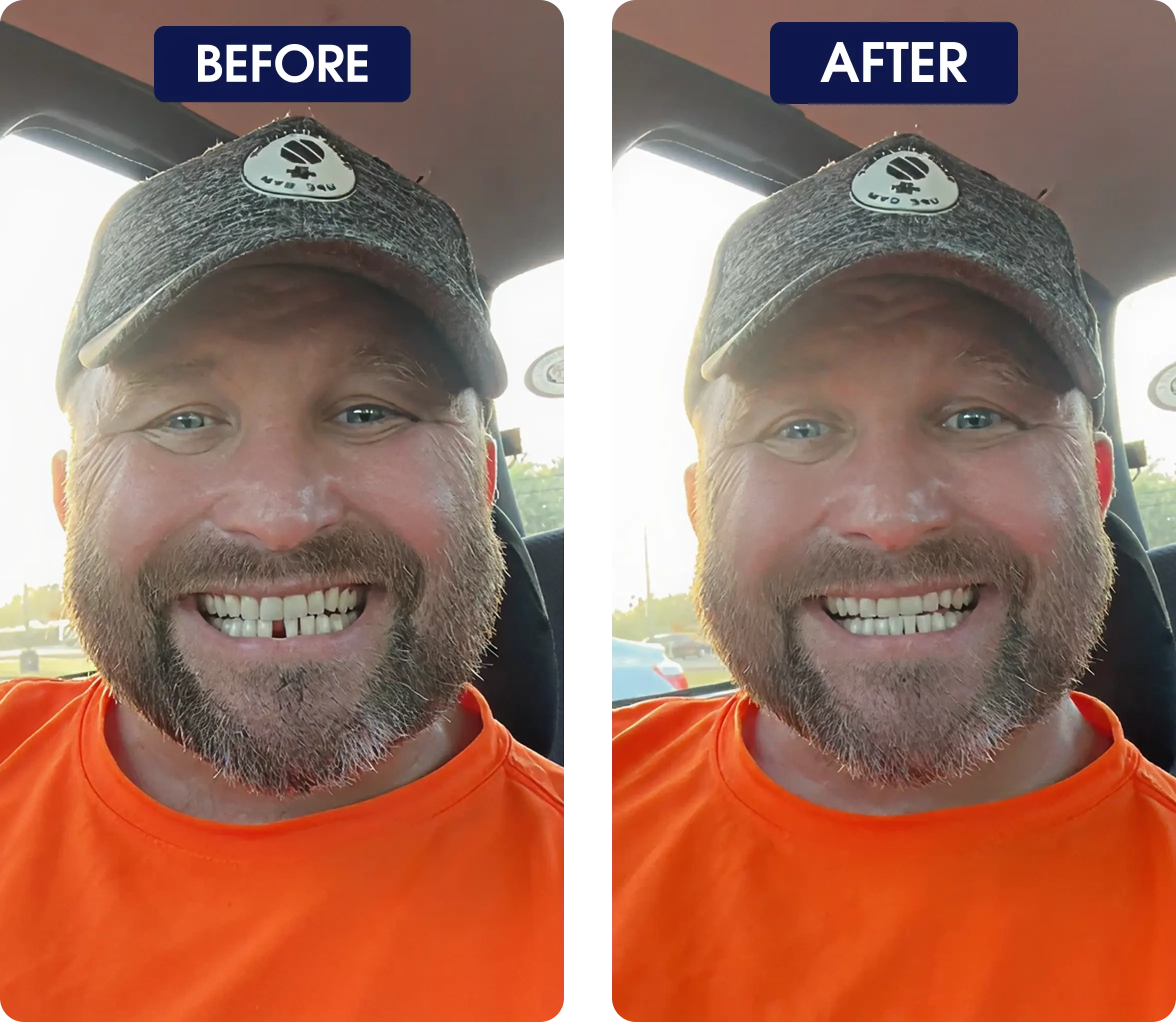 Man missing one bottom tooth on the left and having it replaced on the right