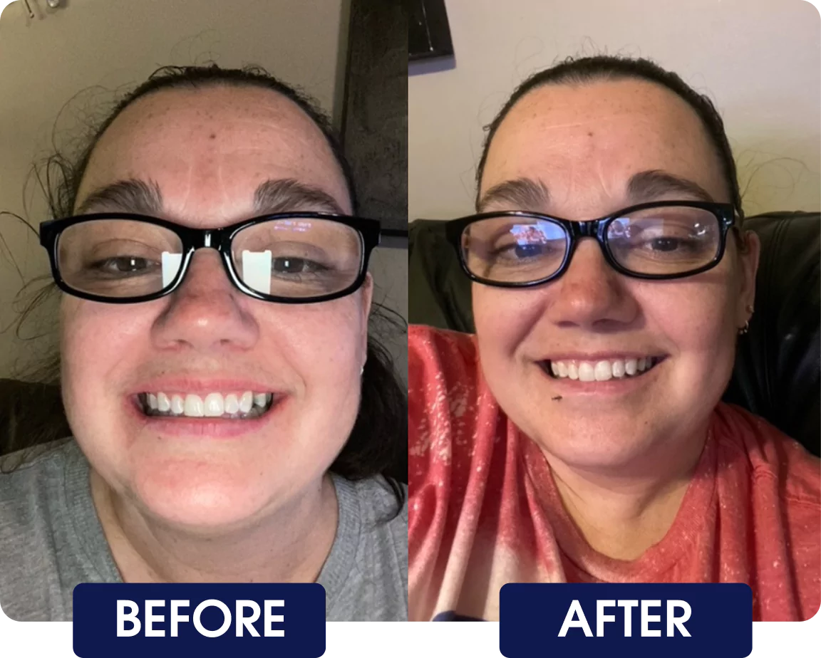 Side-by-side comparison of a woman smiling, labeled 'Before' and 'After.'