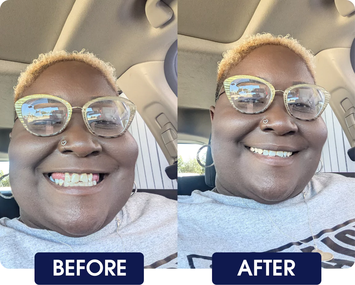 Side-by-side comparison of a person smiling, labeled 'Before' and 'After.'