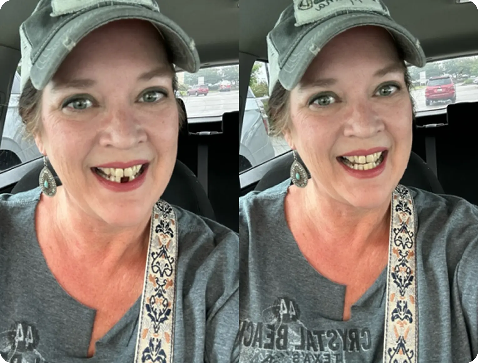 Side-by-side photos showing a woman before and after dental work.