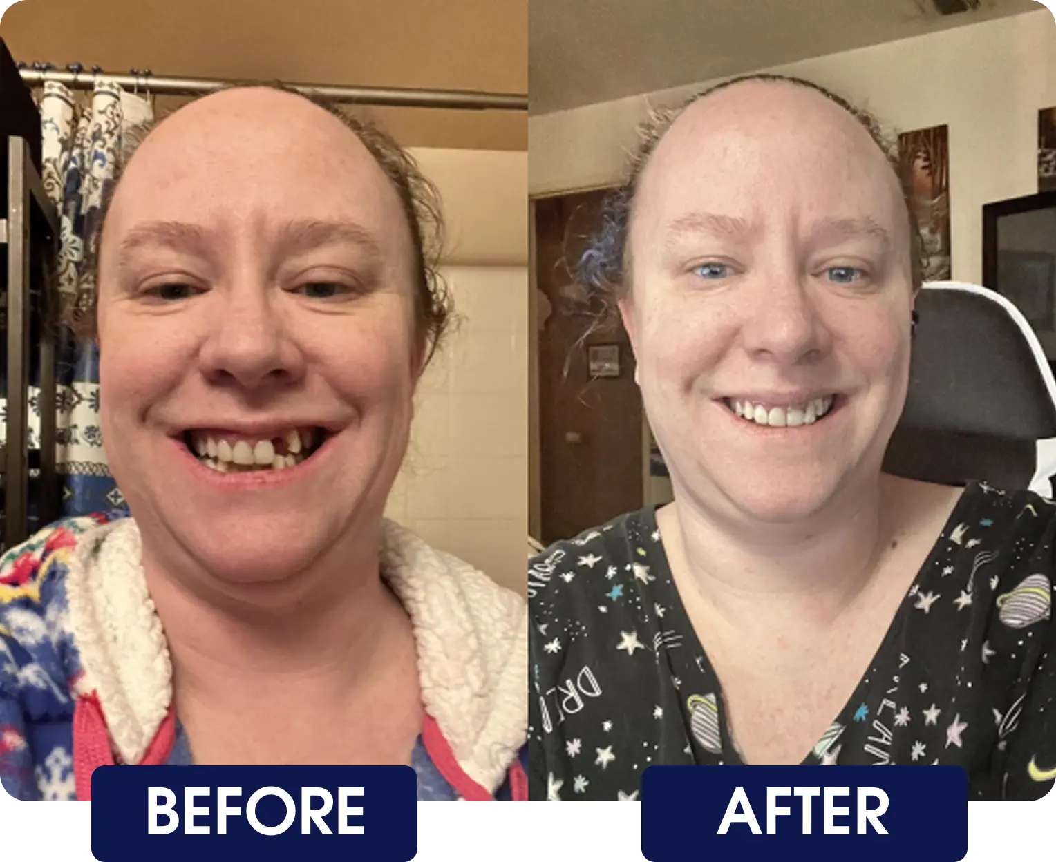 Side-by-side comparison of a person smiling, labeled 'Before' and 'After.'