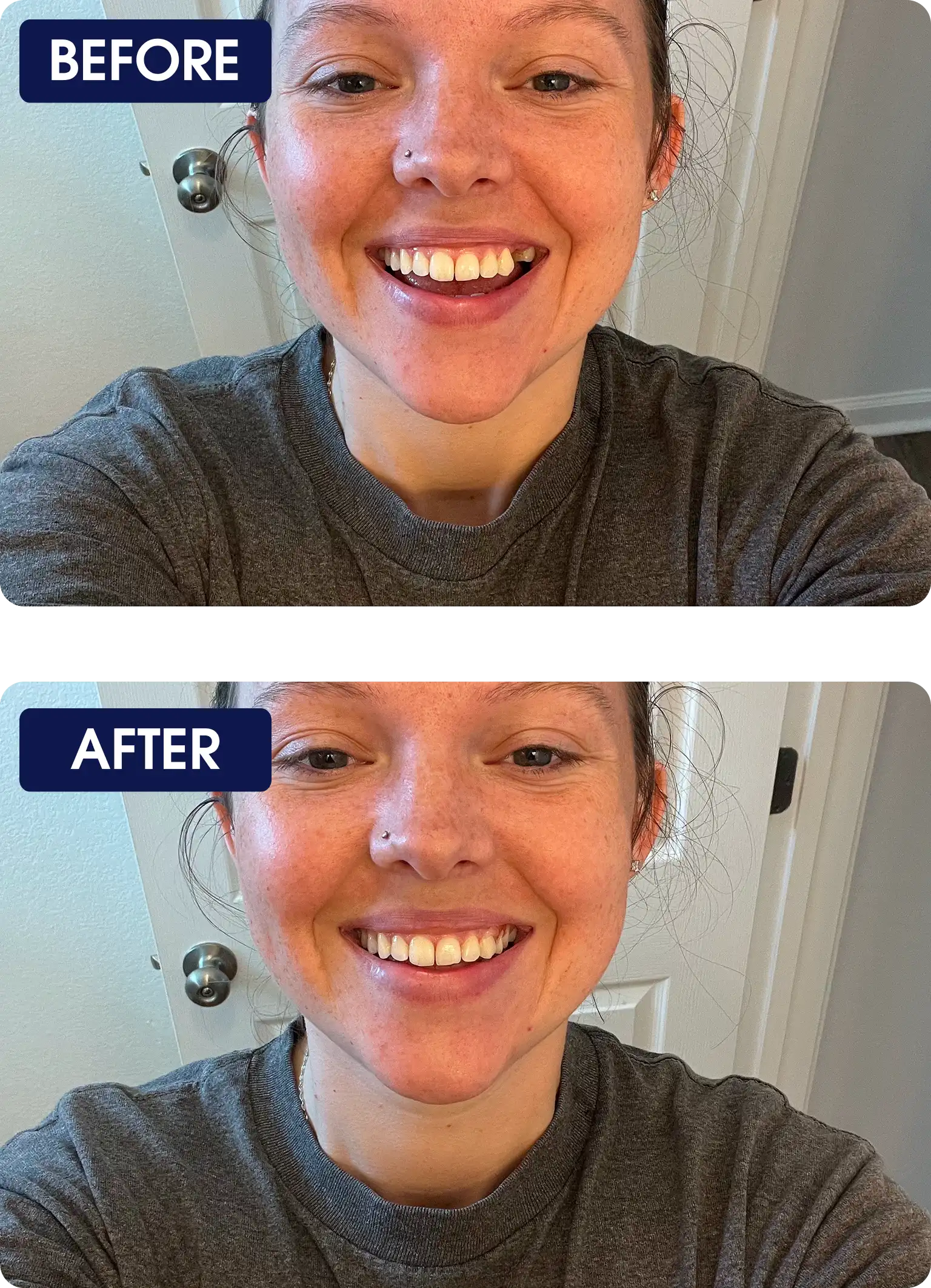 Two side-by-side photos of a person smiling, labeled 'Before' and 'After'.