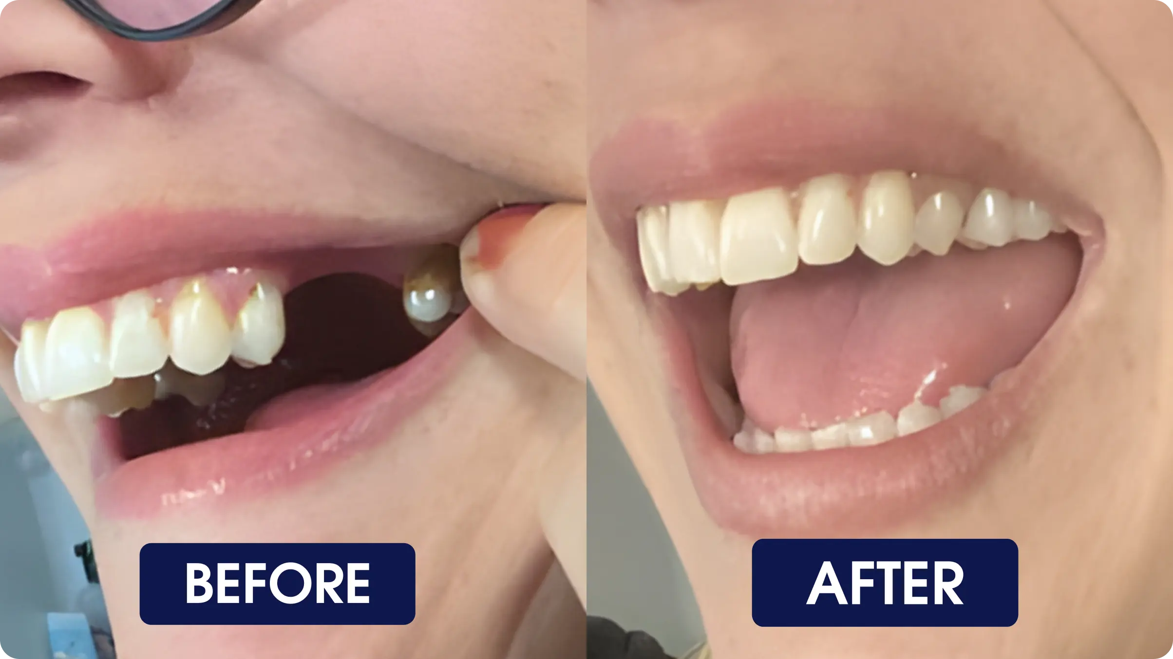 Before and After with woman missing 3 teeth on the left and having those teeth replaced on the right