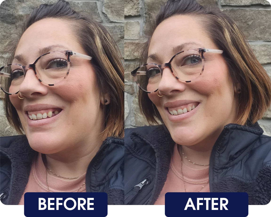 Side-by-side comparison of a woman's smile labeled 'Before' and 'After.'