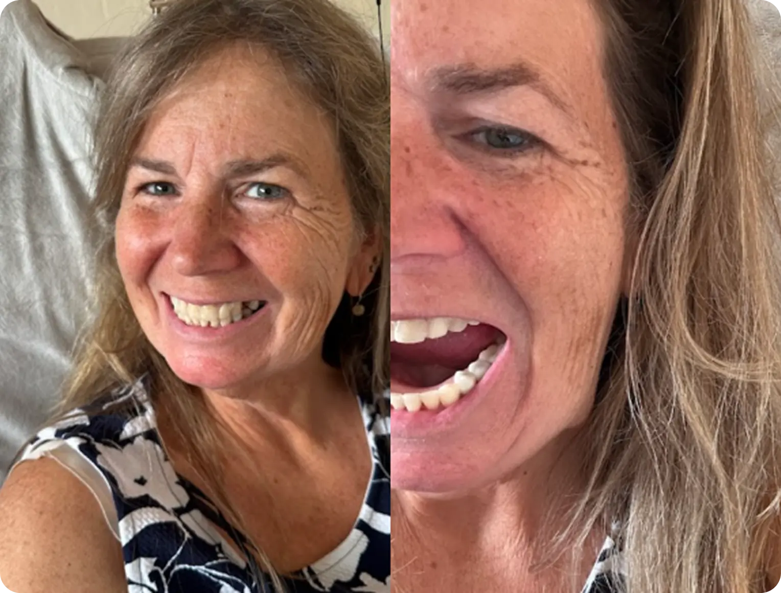 Side-by-side comparison of a woman smiling, labeled 'Before' and 'After.'