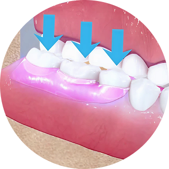 Illustration of teeth with gum treatment and blue arrows pointing down.