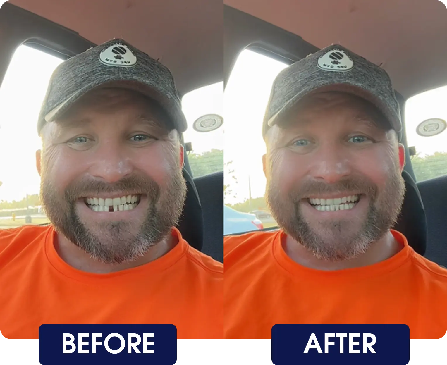 Side-by-side comparison of a man smiling, labeled 'Before' and 'After.'
