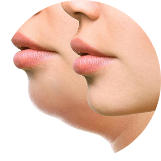 Side-by-side comparison of two profiles showing a chin before and after reduction.