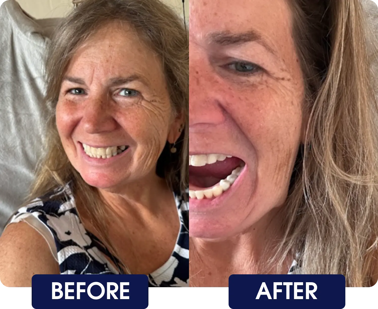 Side-by-side comparison of a woman smiling, labeled 'Before' and 'After.'
