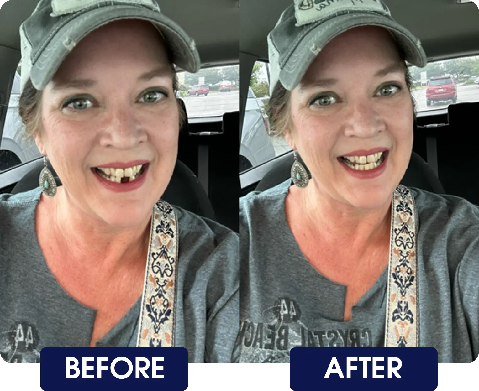 Side-by-side photos showing a woman before and after dental work.