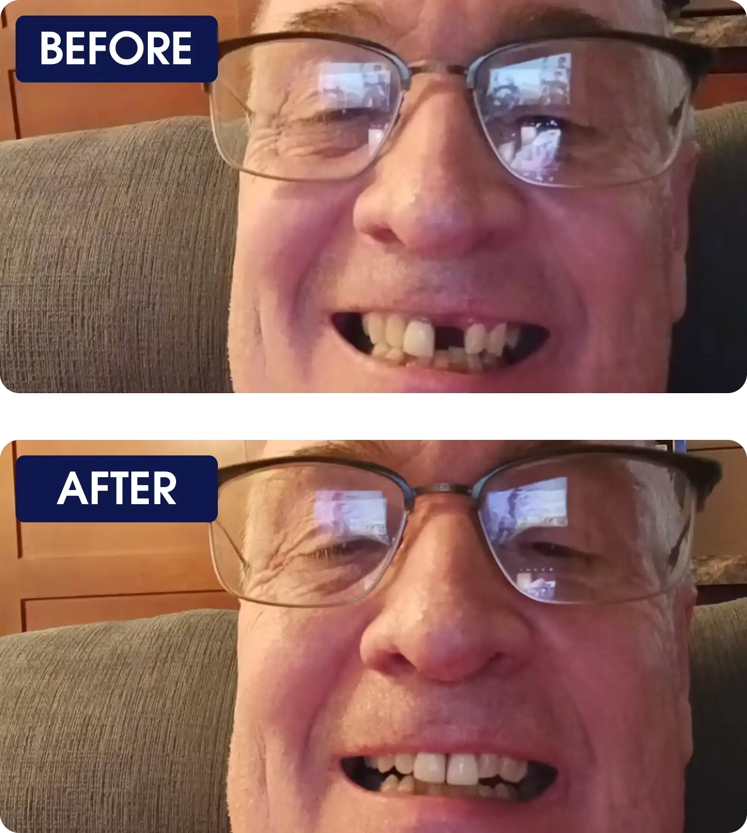 Before and After with a man missing one front tooth and after with the tooth being repalce.