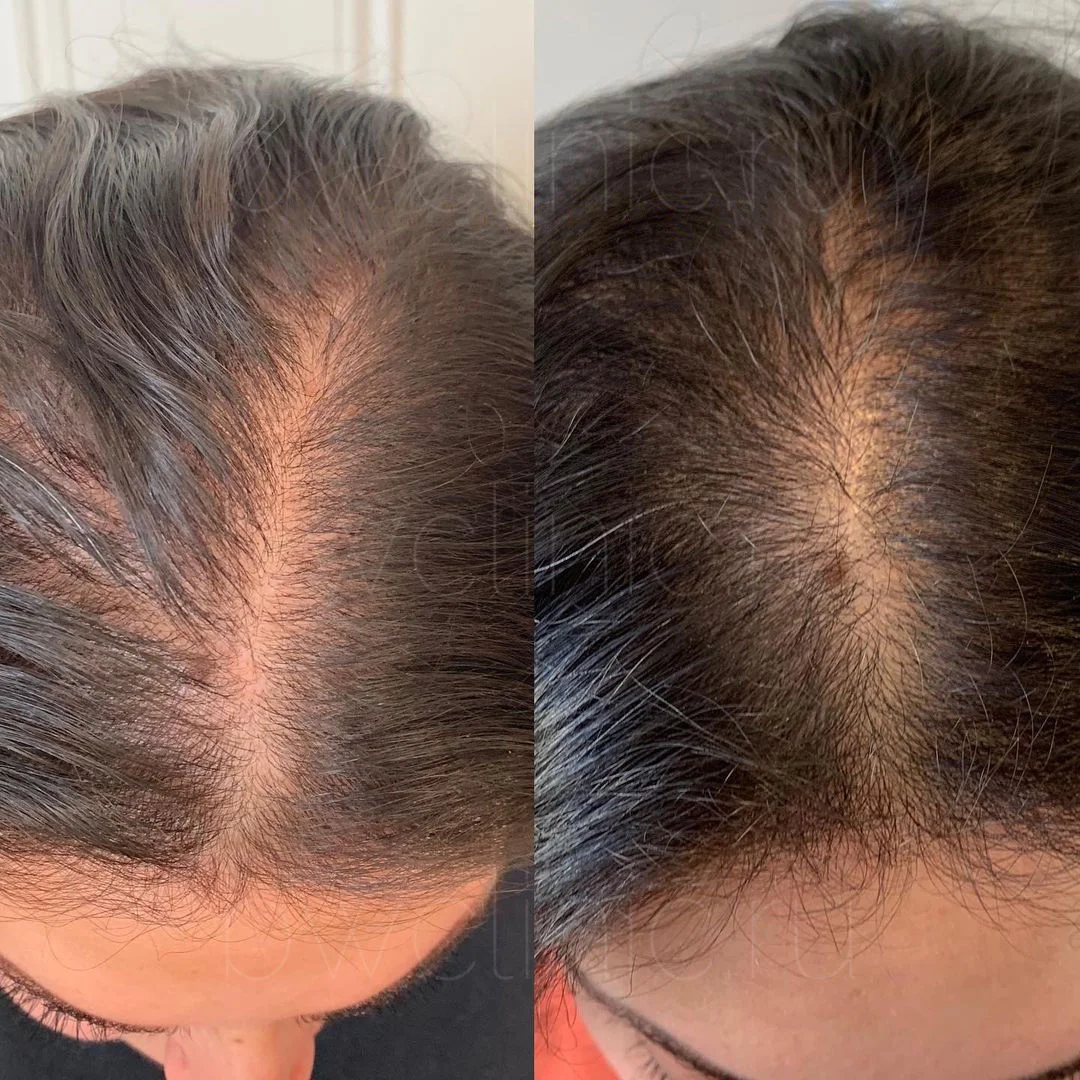 Before and after images of hair growth treatment.