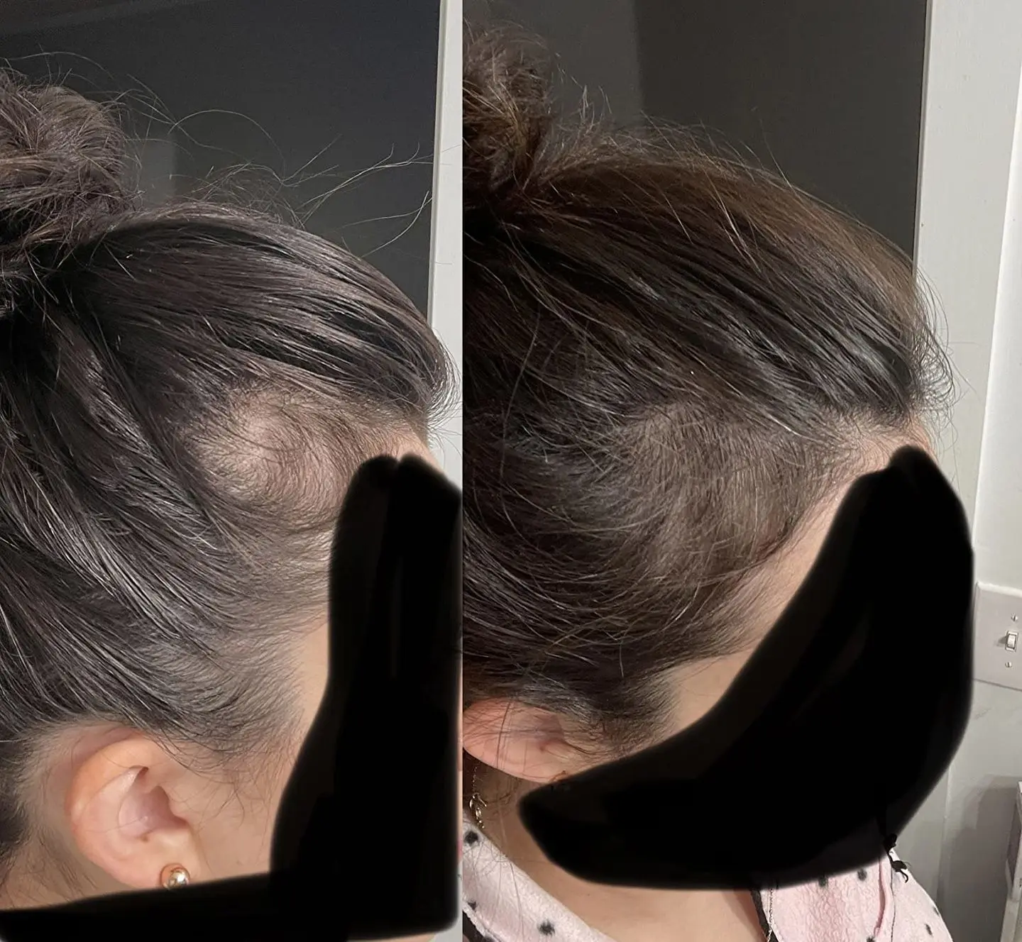 Side-by-side comparison of hair growth on a person's head.