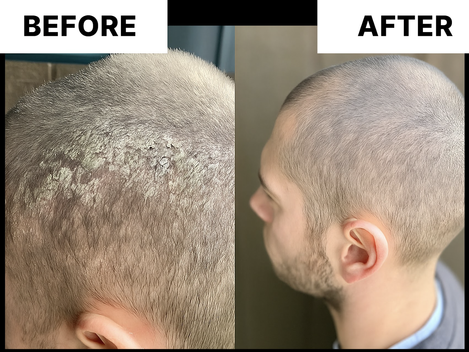 Side-by-side images of a man's scalp before and after treatment.