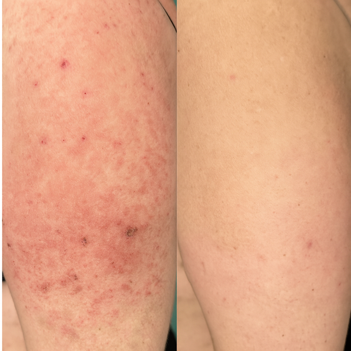 Comparison of skin before and after treatment, showing reduced redness and blemishes.