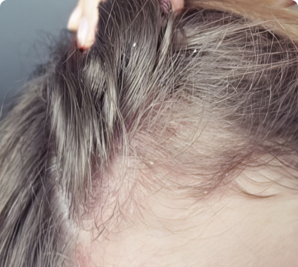 Close-up of a person's scalp with dandruff and hair being parted.