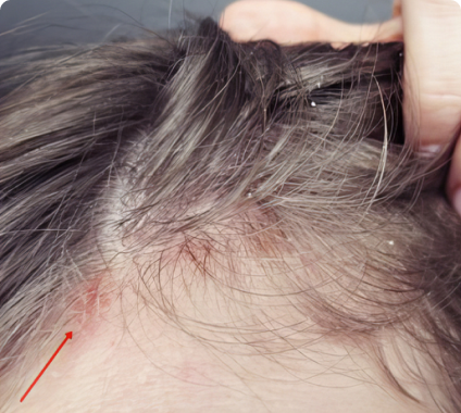 Close-up of a scalp with dandruff and a red irritated area.