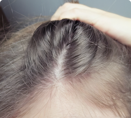 Close-up of a person's scalp with hair parted.