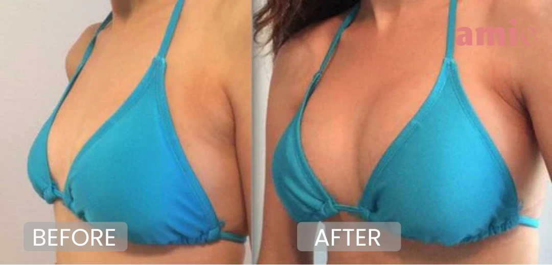 Side-by-side comparison of a woman in a blue bikini, labeled 'Before' and 'After.'