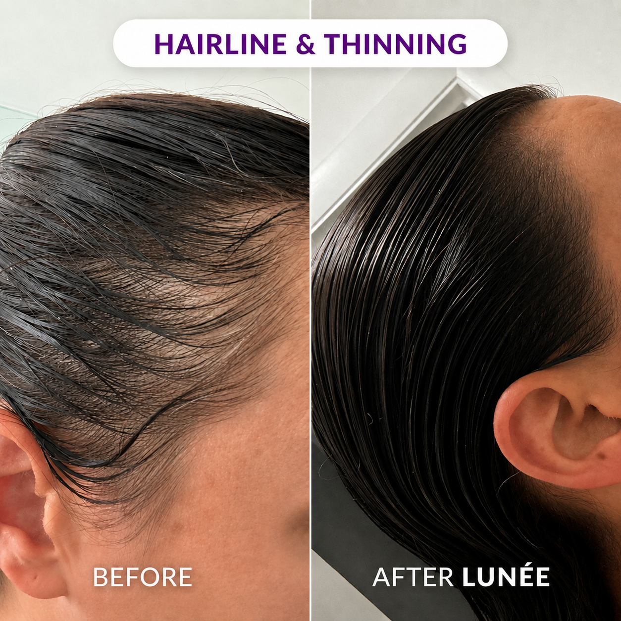 A before and after comparison of a person's hairline, showing less thinning and more hair fullness.