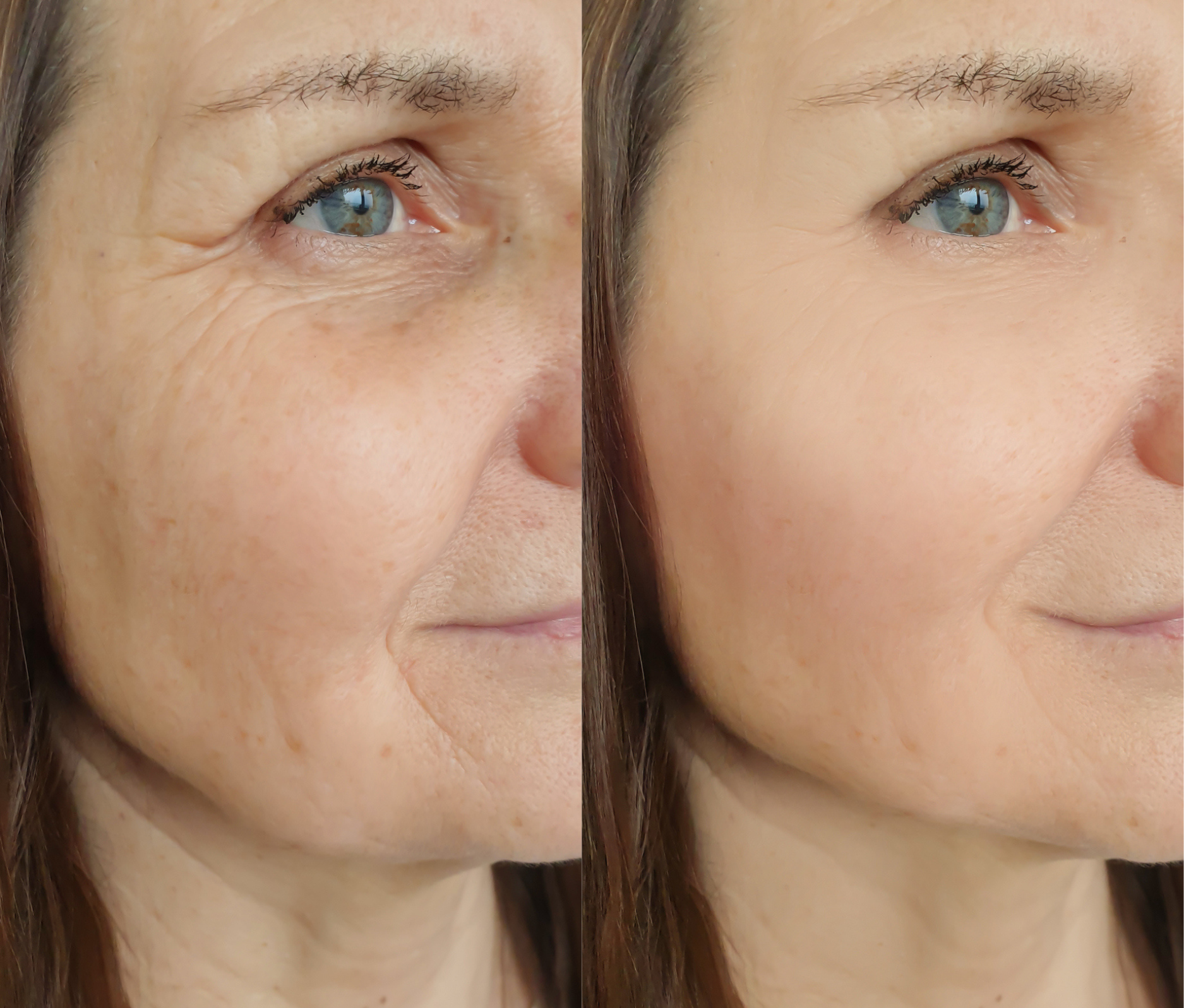 Side-by-side comparison of a woman's face before and after skin treatment.