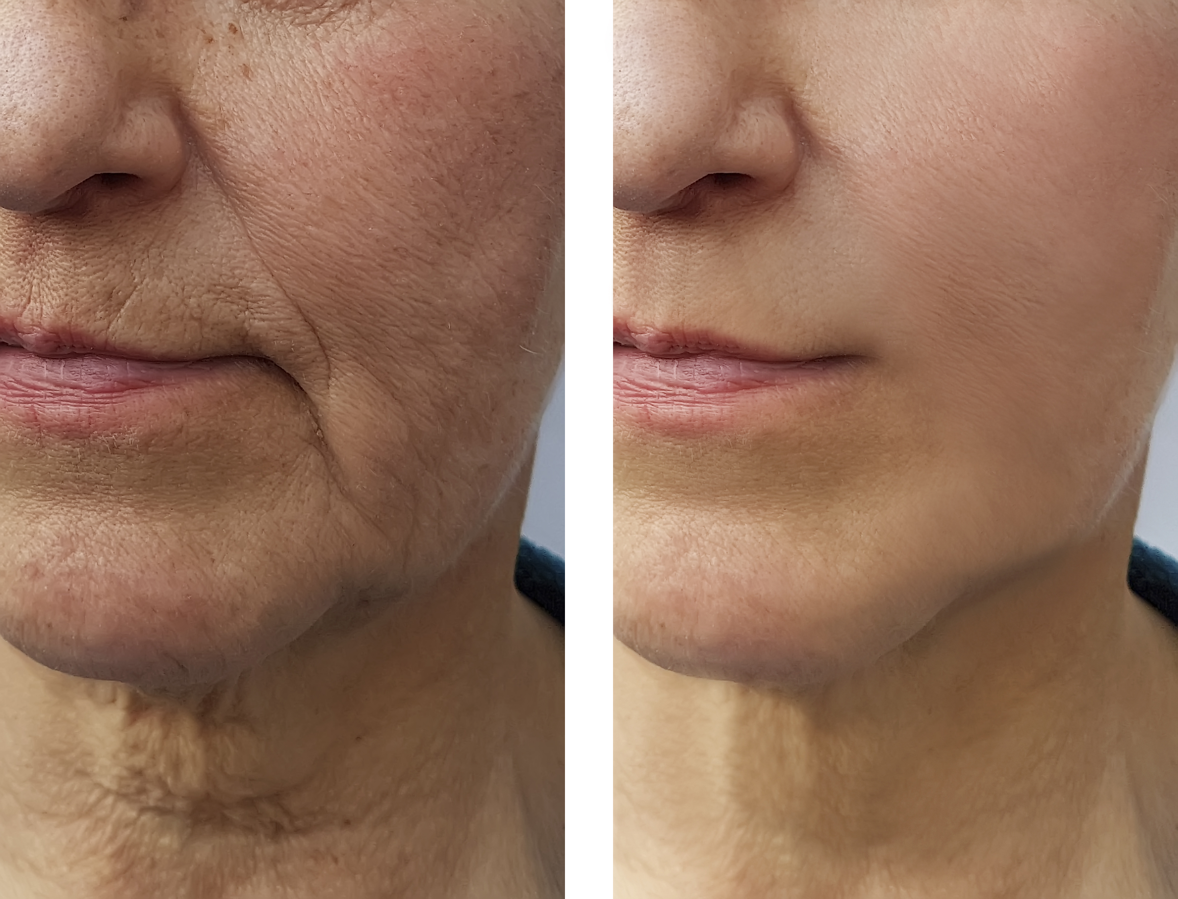 Side-by-side comparison of a face before and after skin treatment.