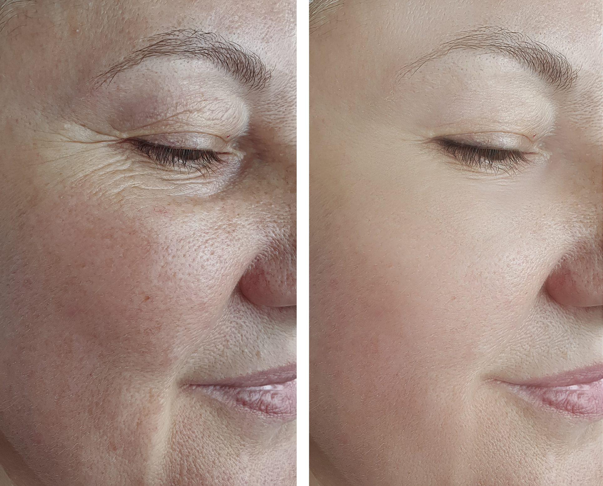 Side-by-side comparison of a woman's face showing skin texture improvement.