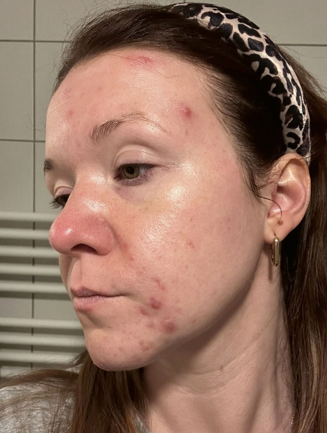 A close-up of a woman's face with acne on her forehead, cheeks, and chin.