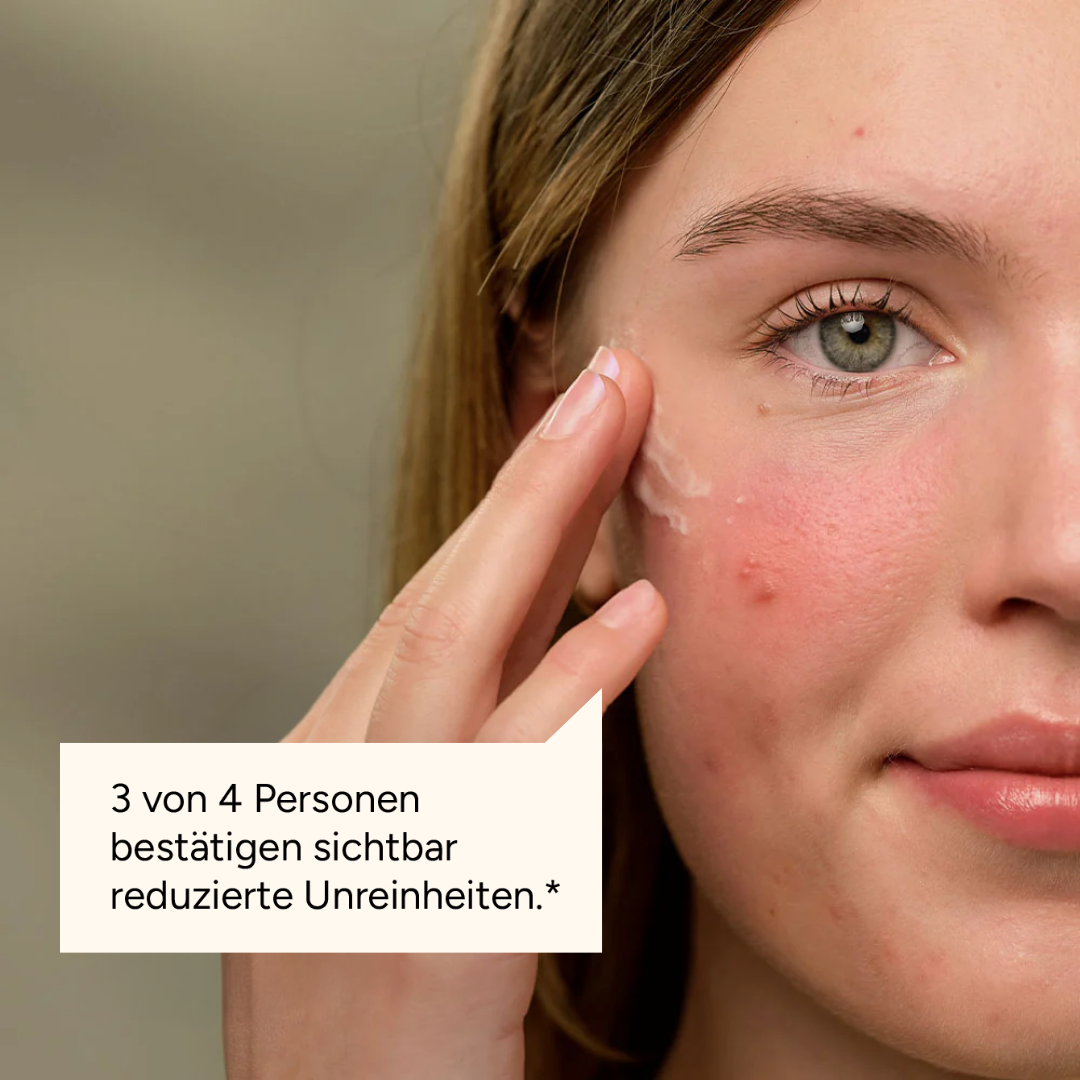 A close-up of a woman applying cream to her cheek, which has some redness and blemishes.