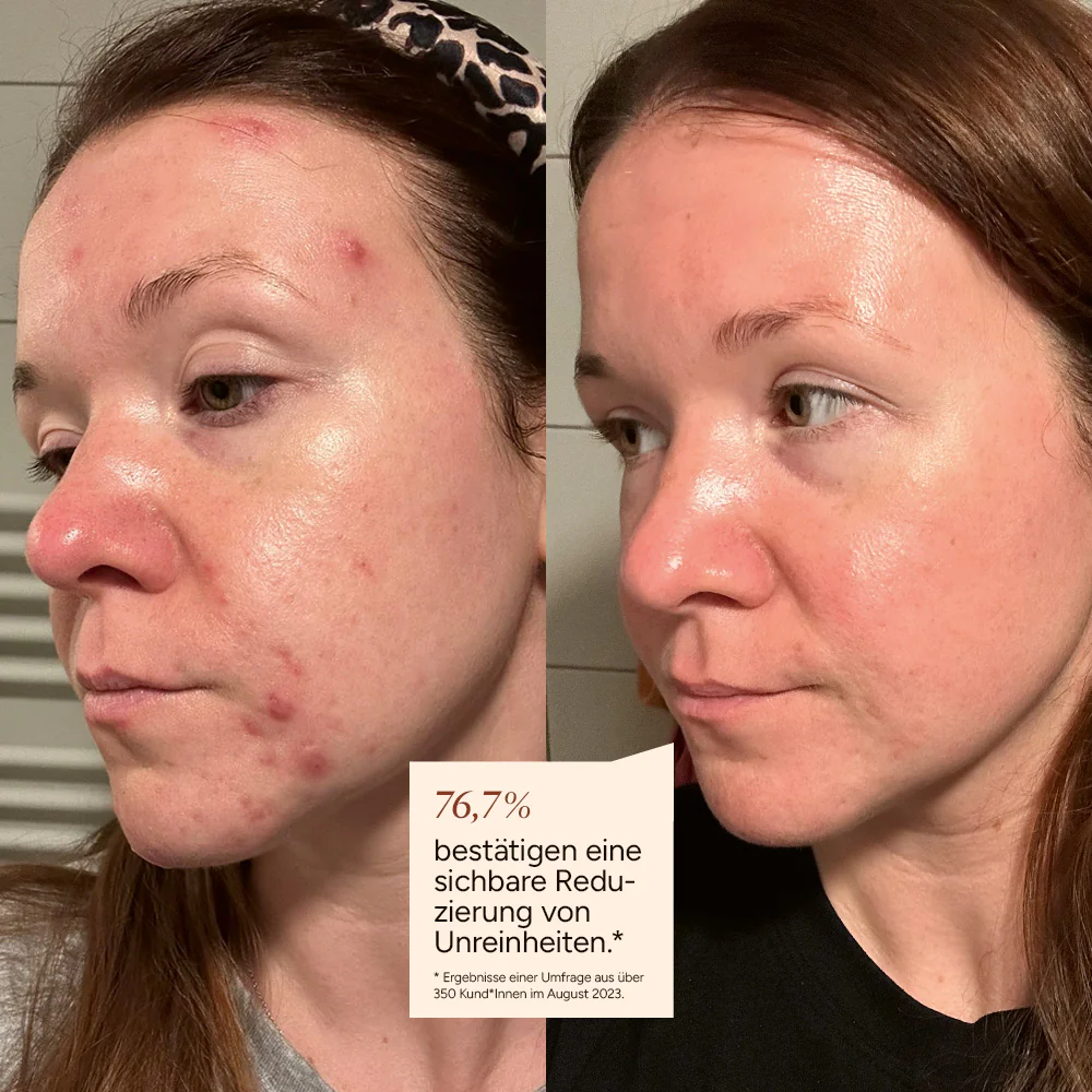 Before and after comparison of facial skin with reduced blemishes.