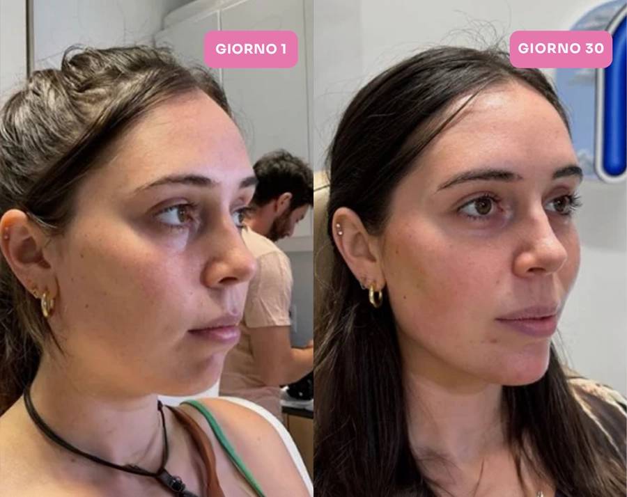 A before and after comparison of a woman's facial profile, labeled Day 1 and Day 30.