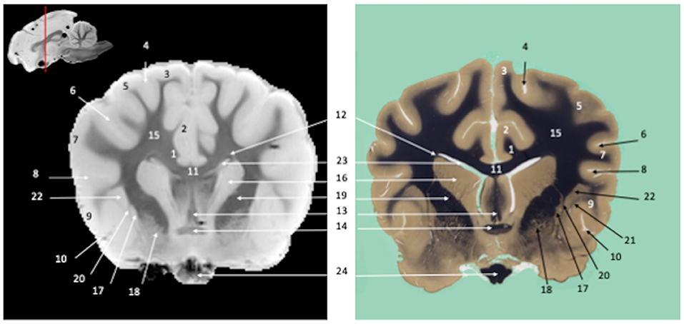 A side-by-side comparison of a labeled brain MRI and a corresponding stained histological slice.