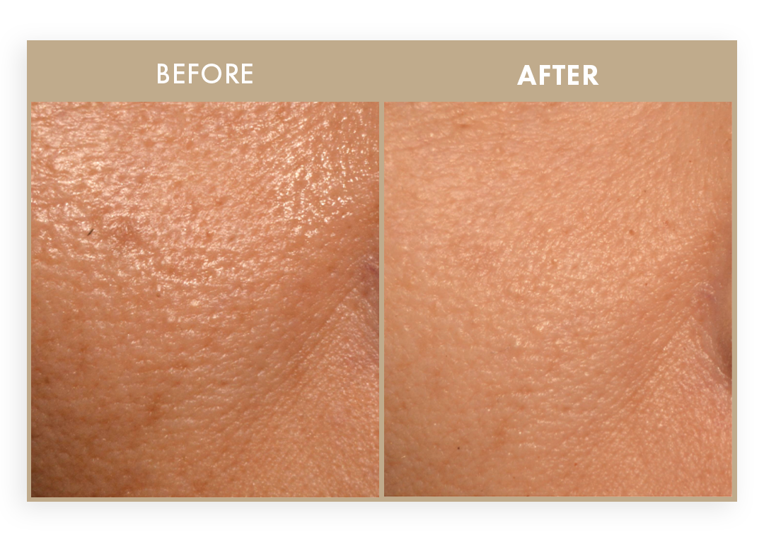Close-up of skin before and after treatment showing improved texture.