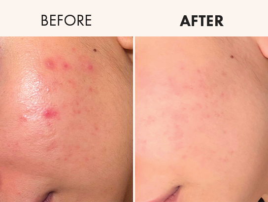 Side-by-side comparison of skin with acne before and after treatment.