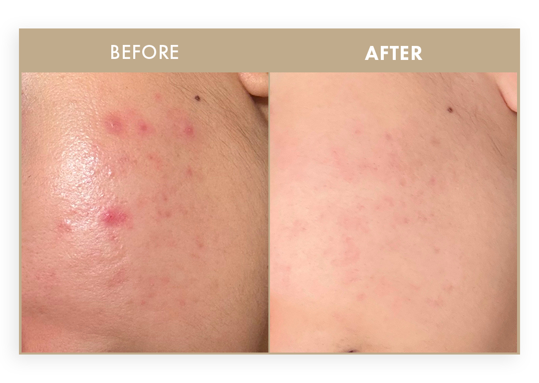 Before and after images showing reduction in facial blemishes.