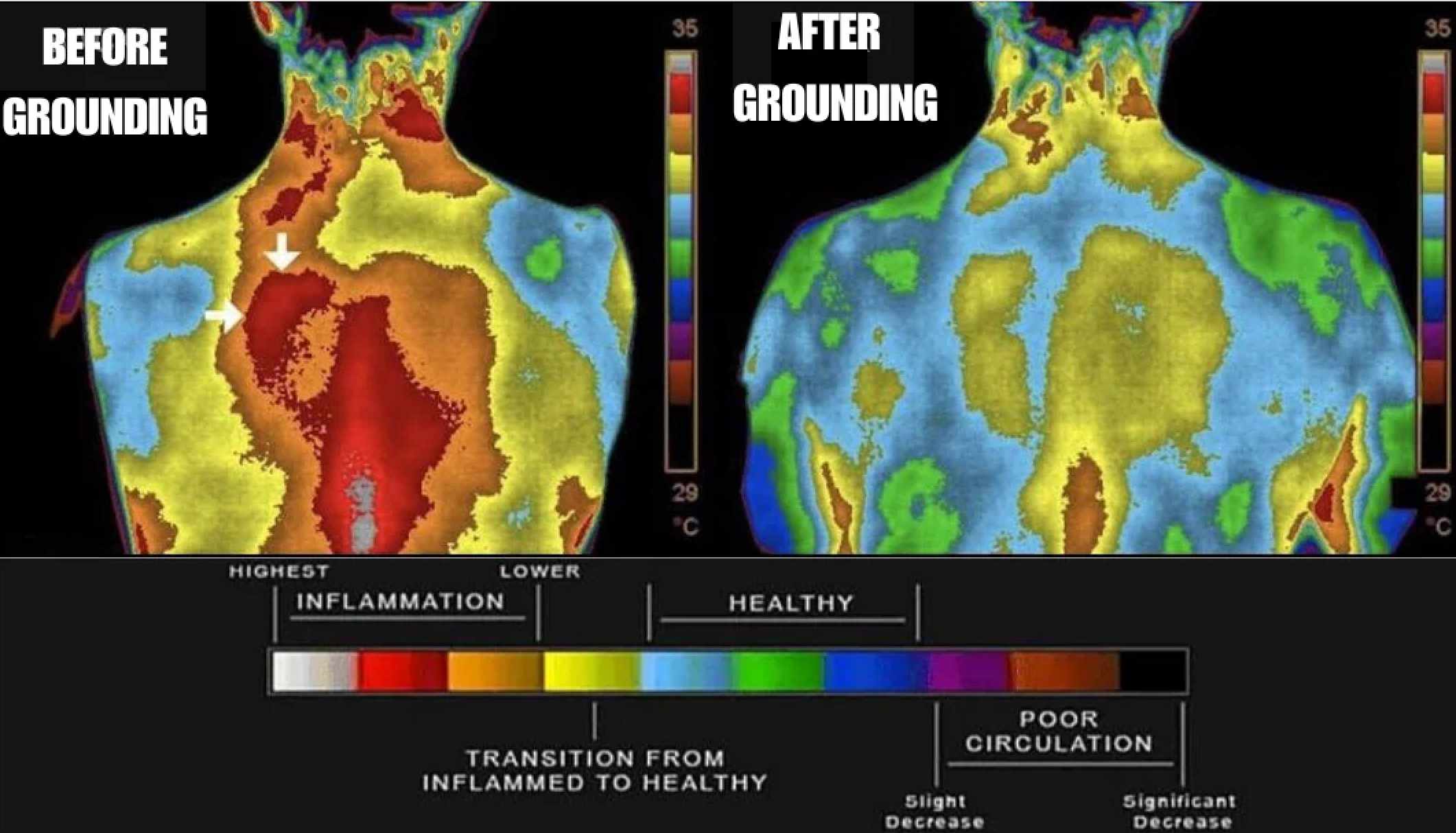 Thermal images comparing body heat before and after grounding, with inflammation scale below.