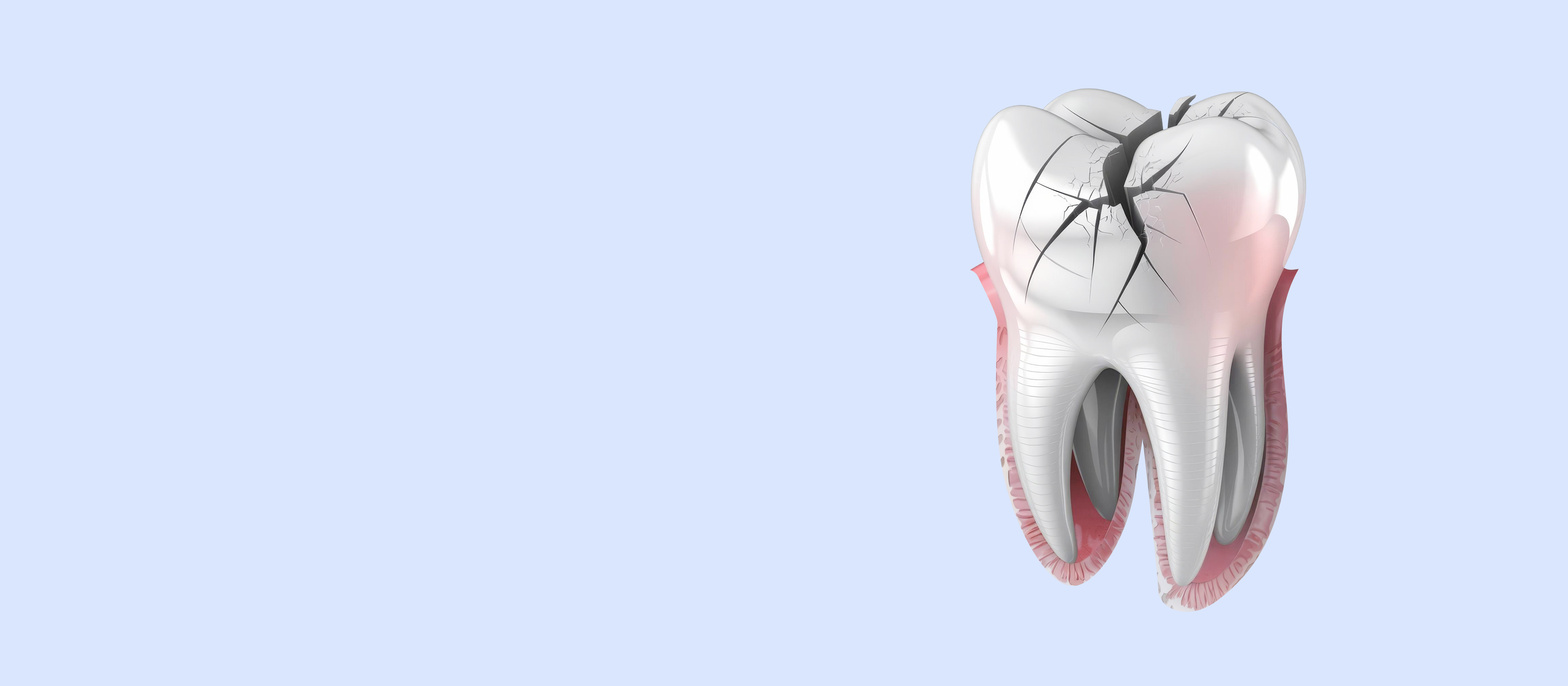 Illustration of a cracked tooth with visible roots and gum tissue.