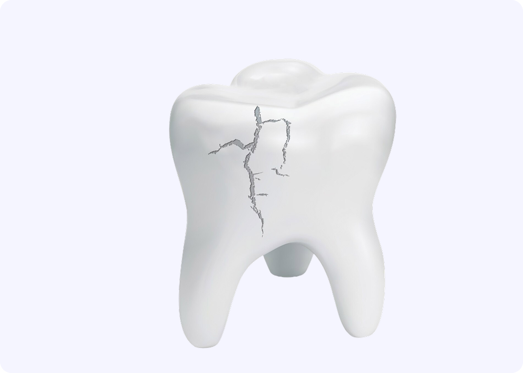 Illustration of a cracked tooth on a light background.